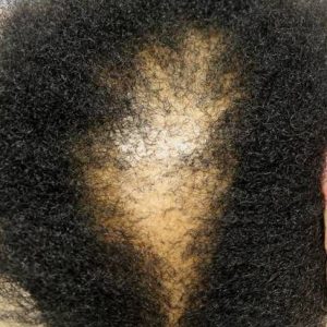 ALOPECIA (HAIR LOSS)